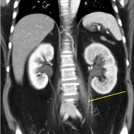Routine conventional CT shows obstructing stone in left ureter (yellow arrow). There are peripelvic cysts in kidney bilaterally.