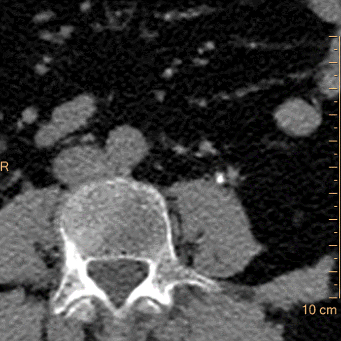 Virtual non-contrast: Stone pops out.