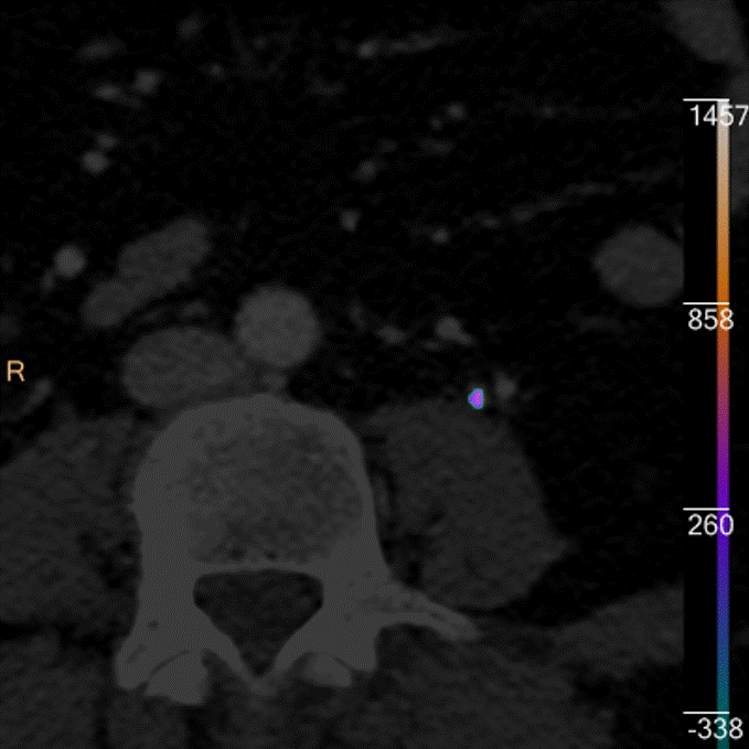 Urinary stone composition