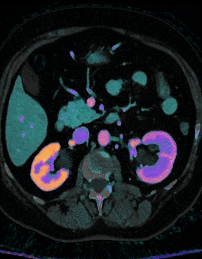 Spectral CT, iodine overlay: Note delayed nephrogram in left kidney.