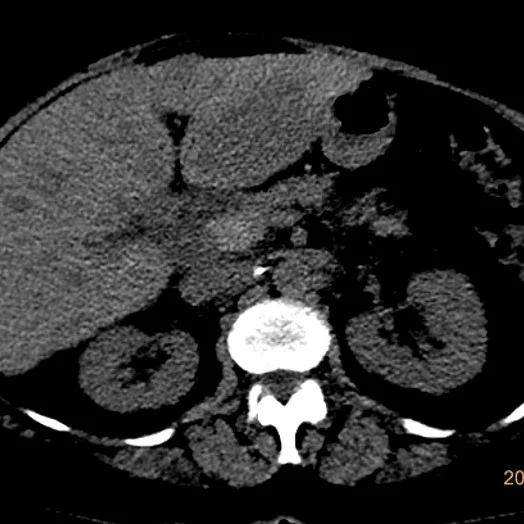 Non-contrast CT: Super subtle liver lesion in left lobe