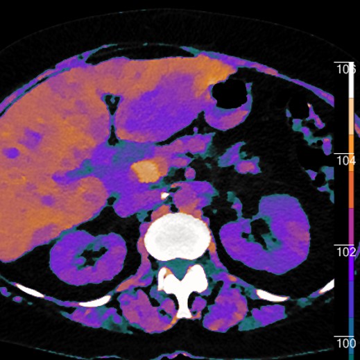 Color overlay with EDW image shows findings to good effect. Notice subtle areas of abnormality in the right lobe.