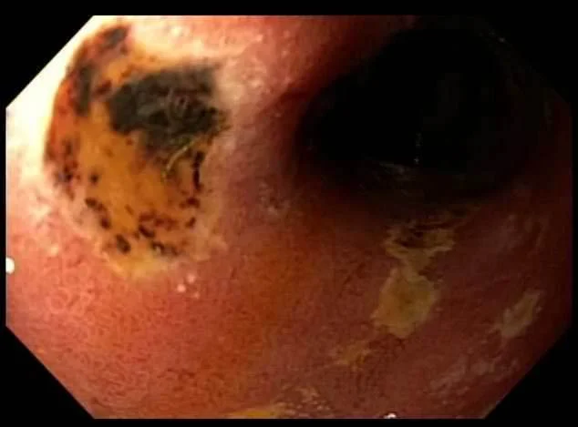 Ulcer in second part of duodenum