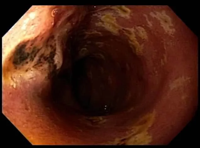Ulcer in third part of duodenum
