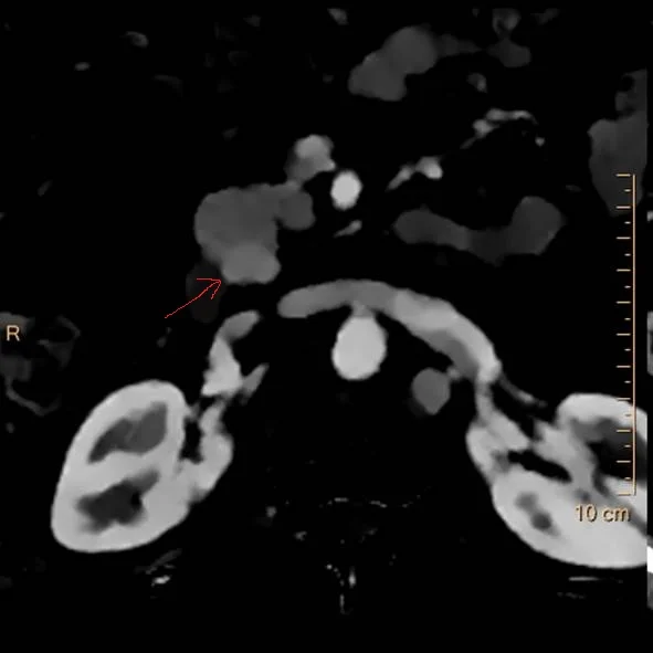 Iodine map: Nodule in uncinate process (red arrow) with well-defined margin.