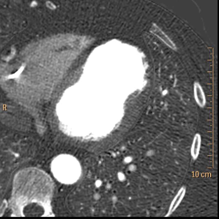 Iodine map: Absent perfusion in the distal anterior wall and apex.