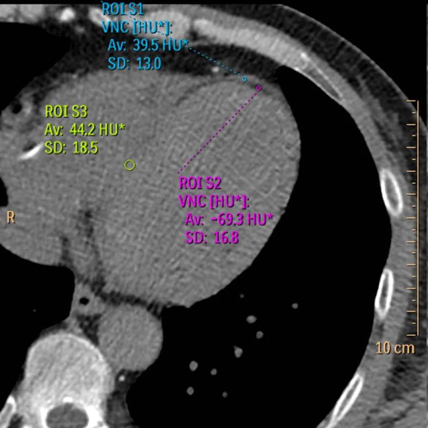 ROI placed in fat (magenta) has density of -69 HU.