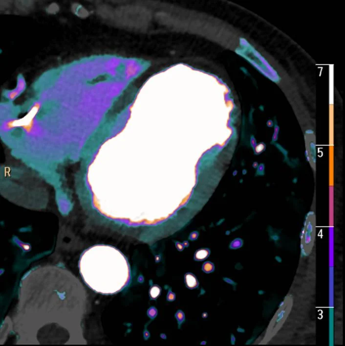 Anatomy of an old infarct