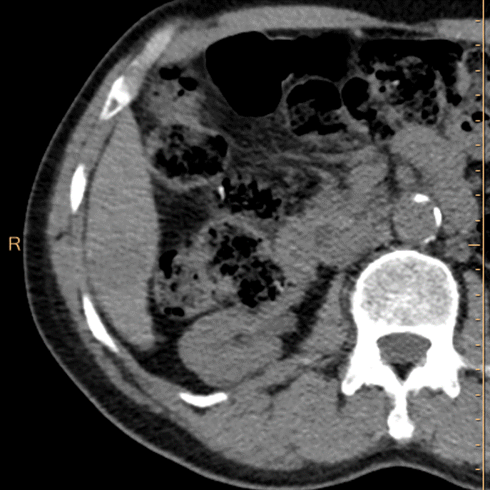 Non-contrast CT. Can you see the lesion?