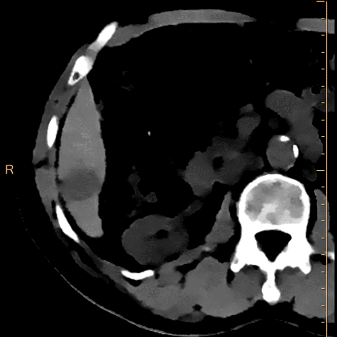 Electron density: Can anyone miss the lesion?