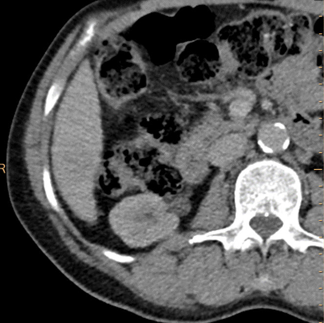 Portal venous phase, conventional phase. You cannot assess for washout, which is one of the major criteria for LiRADS.
