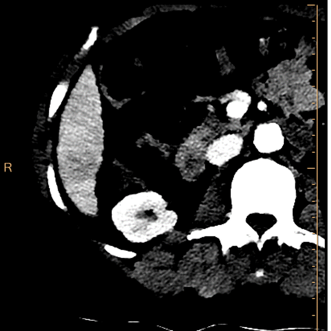 Portal venous phase, 40 keV mono-E. The washout is obvious!