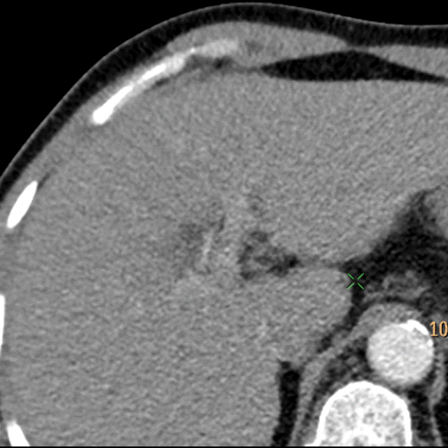 Conventional CT, arterial phase, higher up in the liver. This is unremarkable.