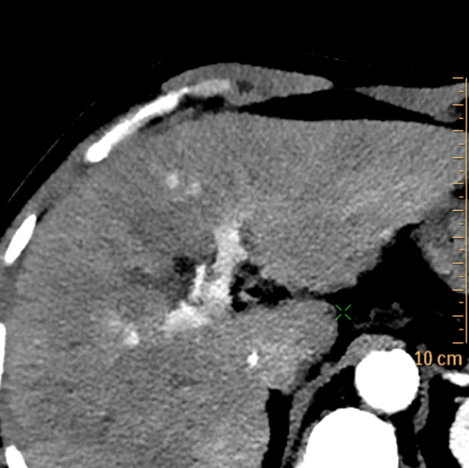 Arterial phase, 40 keV image. See the 2 dots of enhancement?
