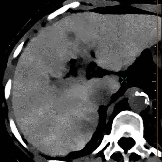 Delayed phase, electron density: The lesion shows up very well. Again, not sure this qualifies as true washout. In any case there is no capsule. I gave this a LiRADS 4, suspicious for HCC.