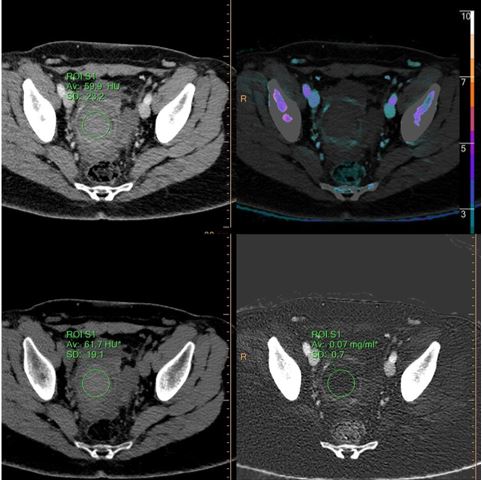 ROI on the clot shows no enhancement, and no iodine uptake.