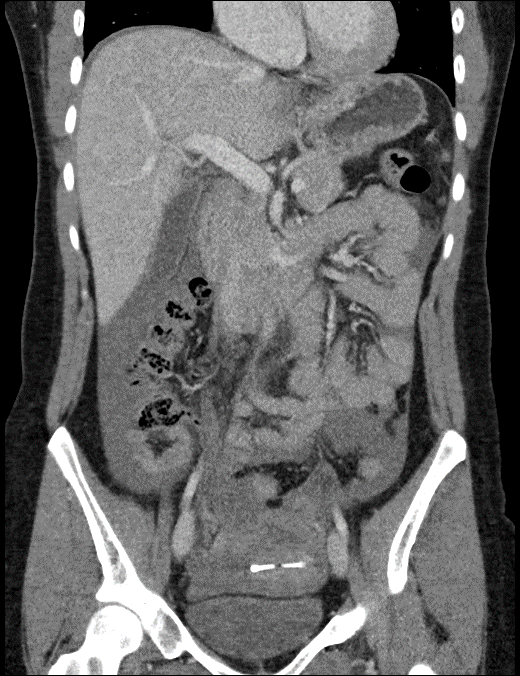 CASE 2: Coronal CT shows large hemoperitoneum.