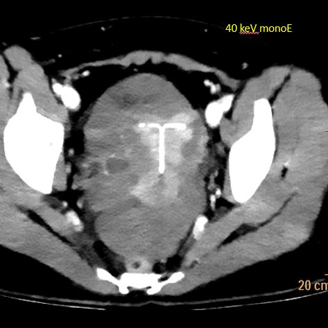 40 keV monoenergy image shows small right adnexal cyst.