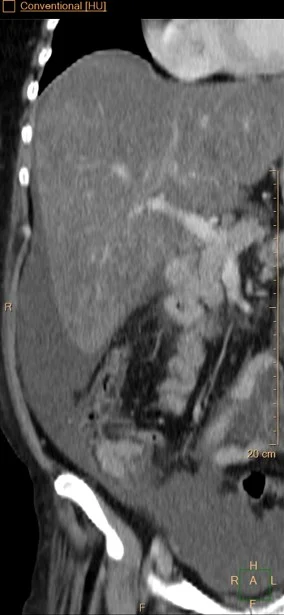 Conventional CT: Fatty liver.
