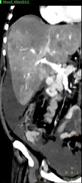 40 keV monoE: Heterogeneous liver, now see the cecal mass pop into view!