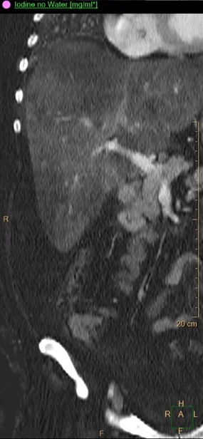 Iodine map: same as above. Notice the stalk.