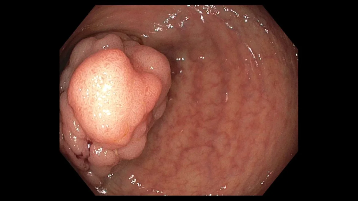 Colonoscopy: Cecal tubular adenoma.