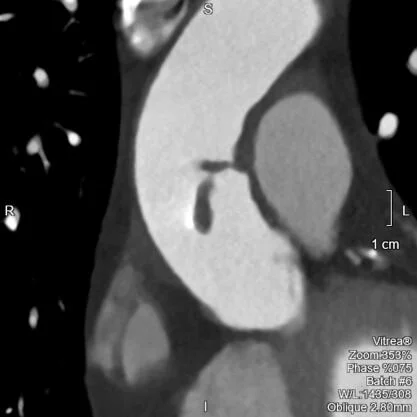 The case of the two infarcts