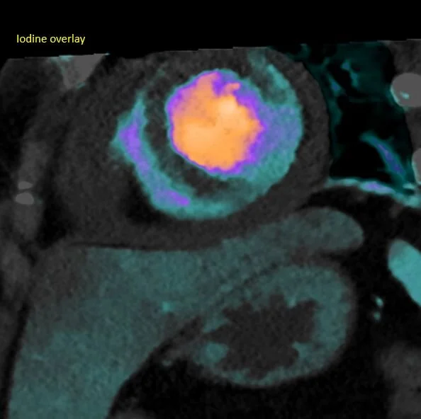 No-reflow on abdomen CT