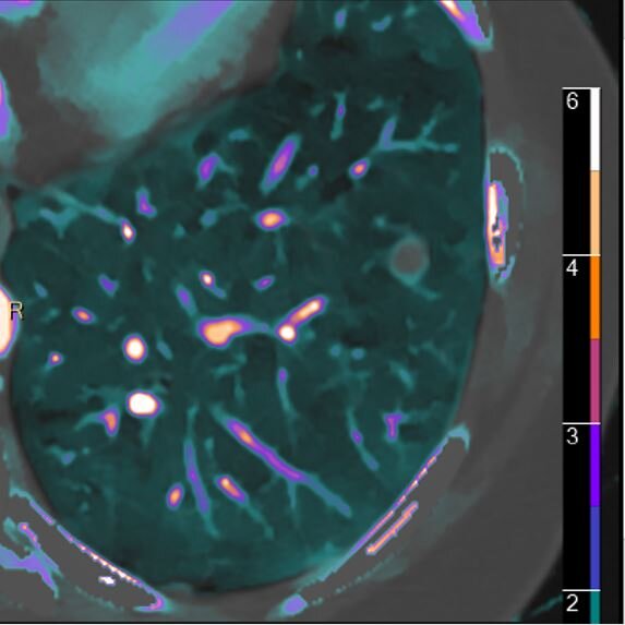 Lung nodule: Spectral and volumetric.