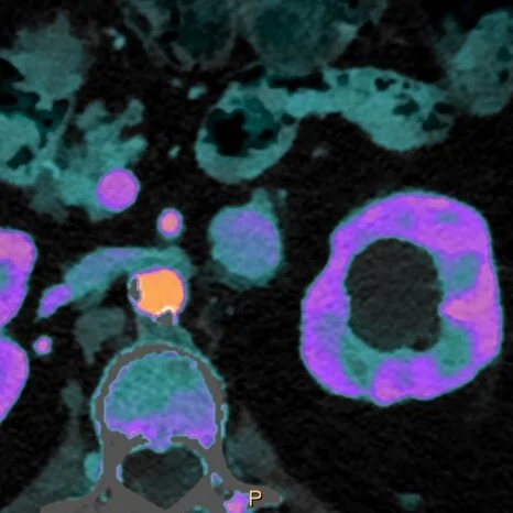 Something new for adrenal nodules