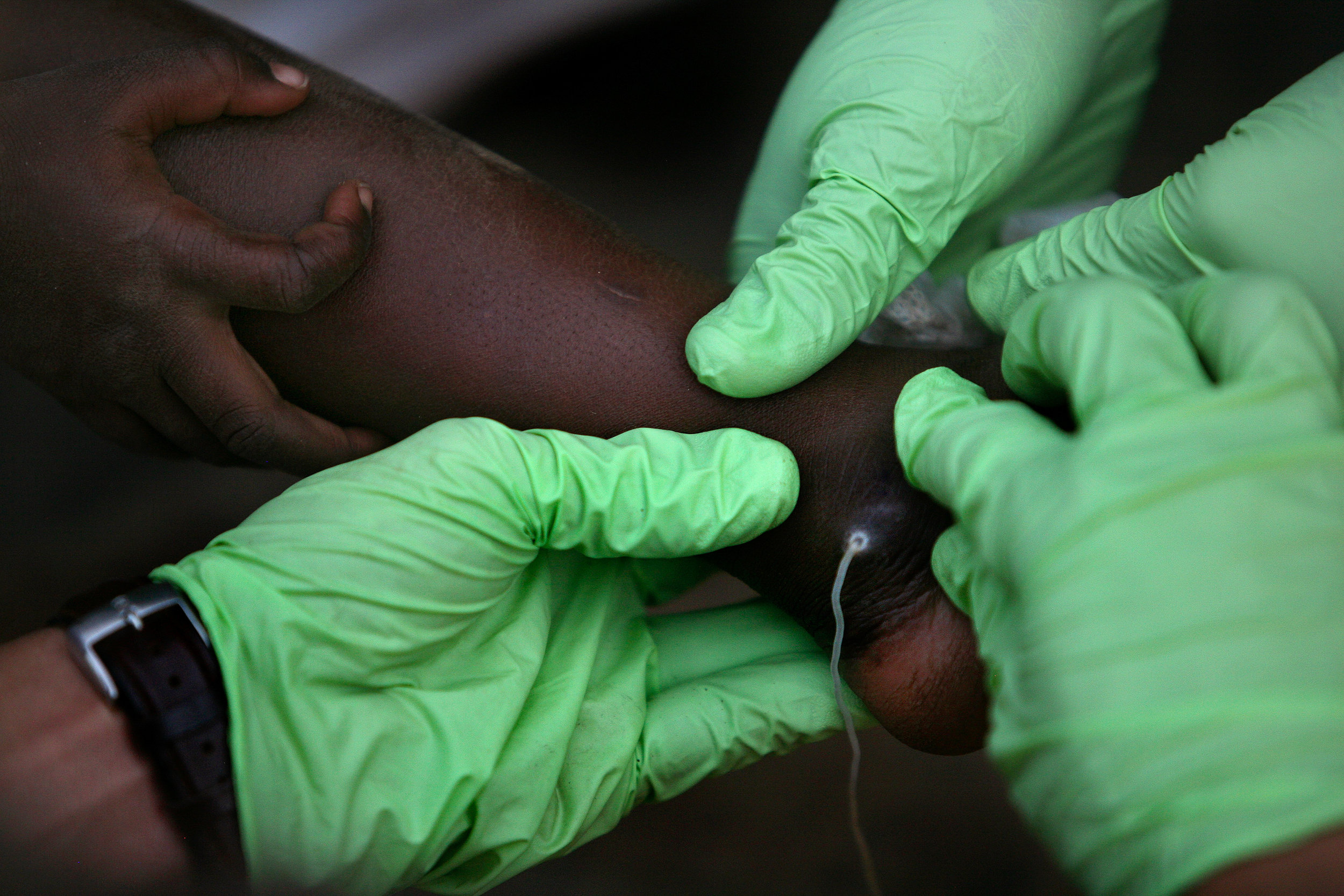  Health workers massage the area around a Guinea worm on four-year-old Samata Baba's ankle, hoping to pull more of the worm out, at Samata's home in Savelugu, Ghana on Jan. 26, 2008. During a painful bandaging routine, a patient's worm is pulled a li