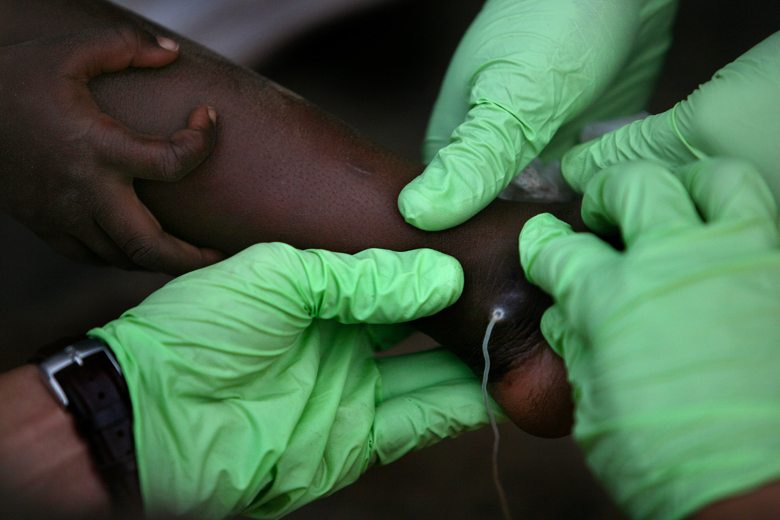 Health workers massage the area around a Guinea worm on four-year-old Samata Baba's ankle, hoping to pull more of the worm out, at Samata's home in Savelugu, Ghana on Jan. 26, 2008. During a painful bandaging routine, a patient's worm is pulled a little bit every day and then wound onto a piece of gauze and bandaged in place.