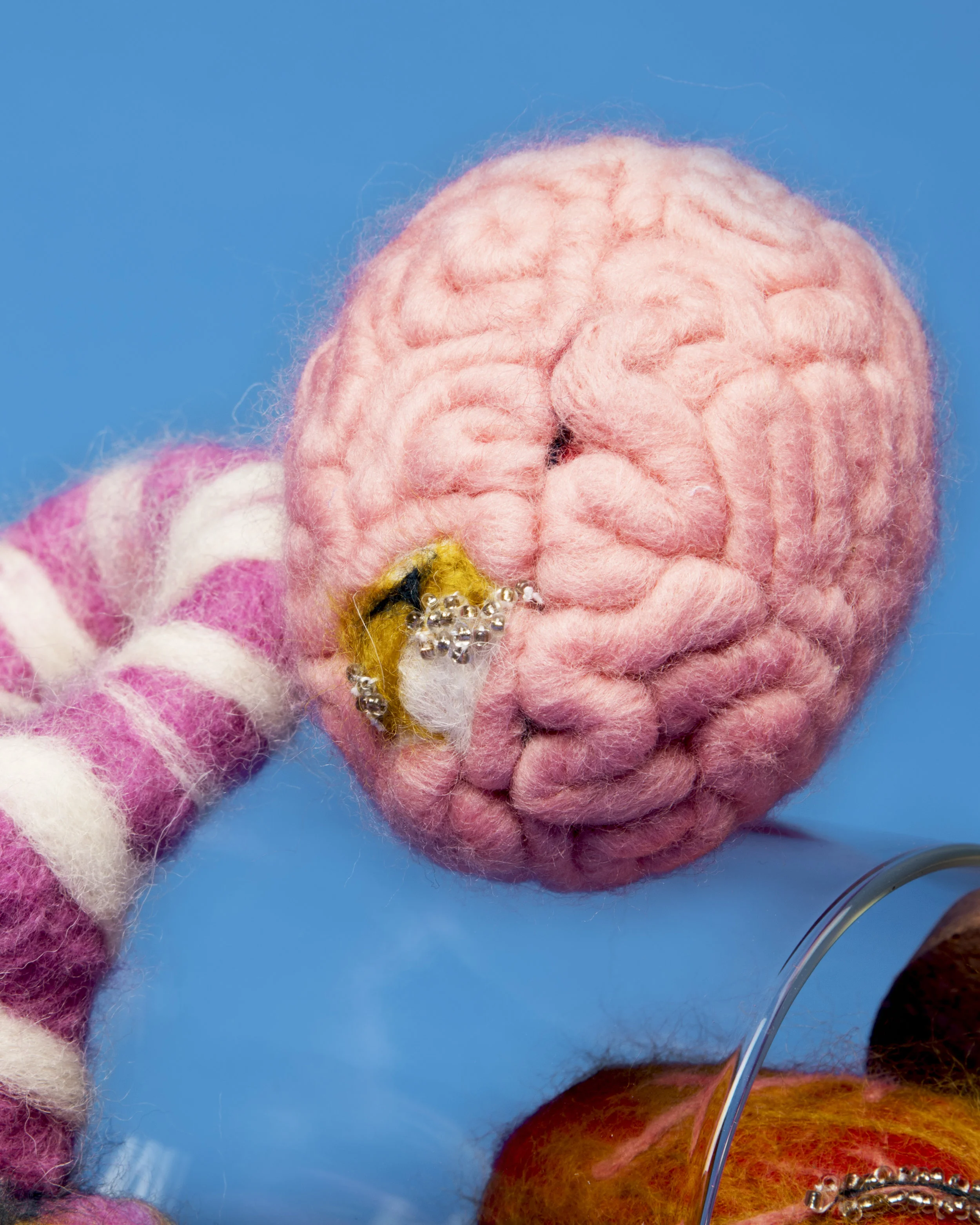 Brain Tumor in the Frontal Lobe