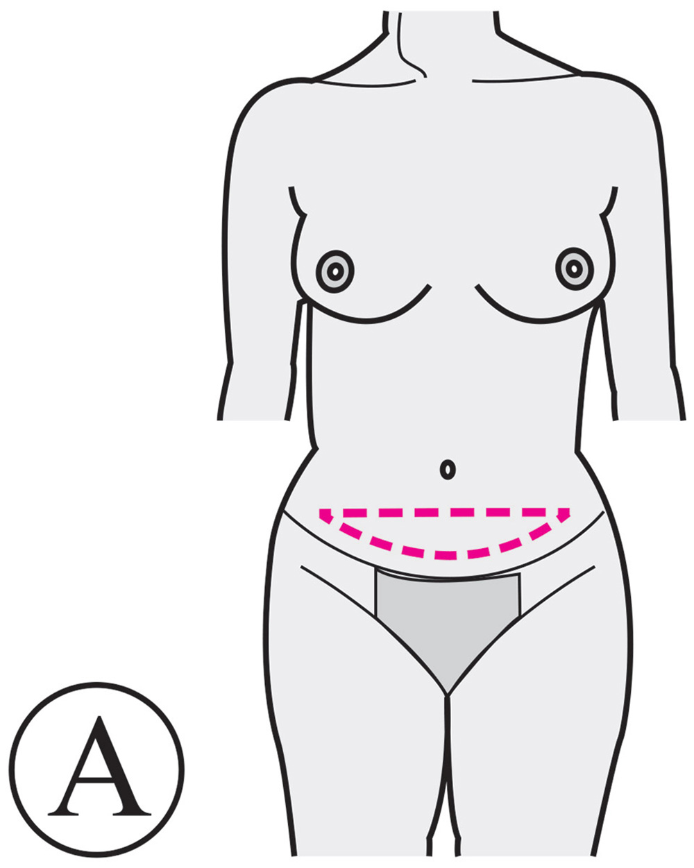 Mini Abdominoplastie Avant