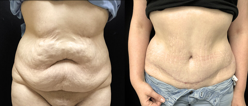 Gaine Médicale Abdominoplastie - Chirurgie Abdominale