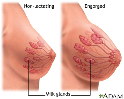 6 tips to treat breast engorgement while breastfeeding