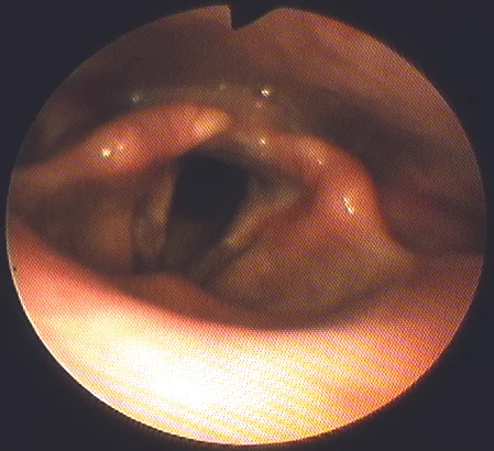 nosescope6larynx.jpg