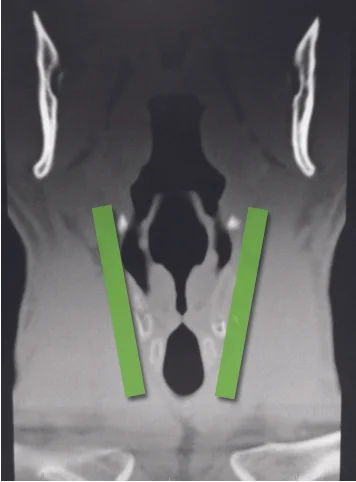 Rhomboid.jpg