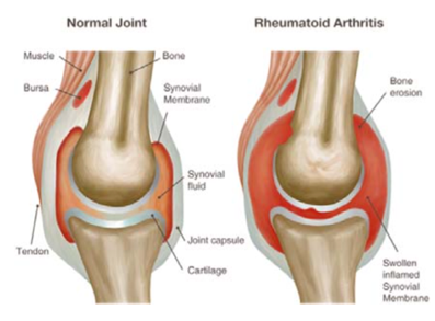 rheumatoid arthritis.png