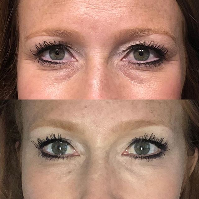 This beautiful mother of 3 just texted me her before and after selfies of her under eyes we filled 2 weeks ago. She is ecstatic with her results. The best part is that it will last up to 2 years. Winning. #filler #lessismore #byebyeteartrough #byebye