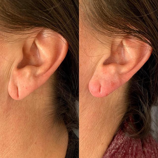 Ladies! No need to walk around with saggy deflated lobes.They can easily be improved in 5 minutes with a hyaluronic acid filler. Book online at tmedaesthetics.com. #juvaderm #earlobecorrection #lift #rejuvenate #allergan #wearearringsagain #tmedaesth