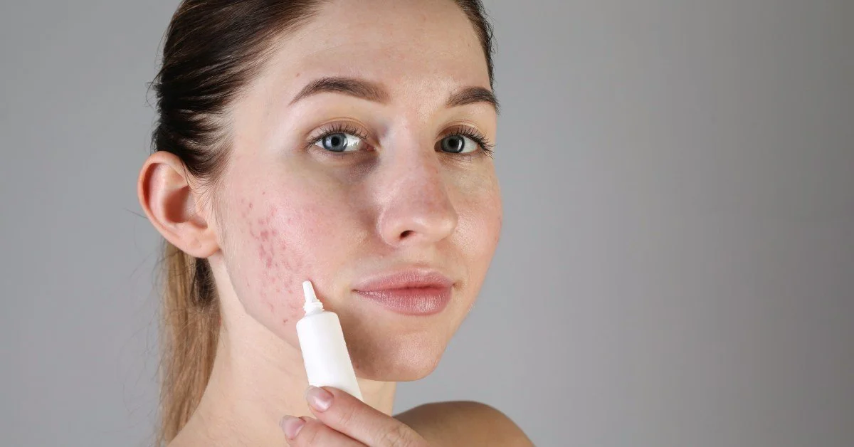 Tips for Getting Rid of Acne and Scars Before Your Wedding