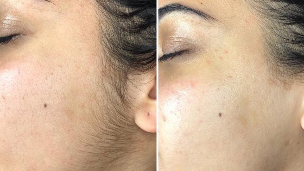 dermaplaning_before_and_after-1296x728-body_1-1024x575.jpeg