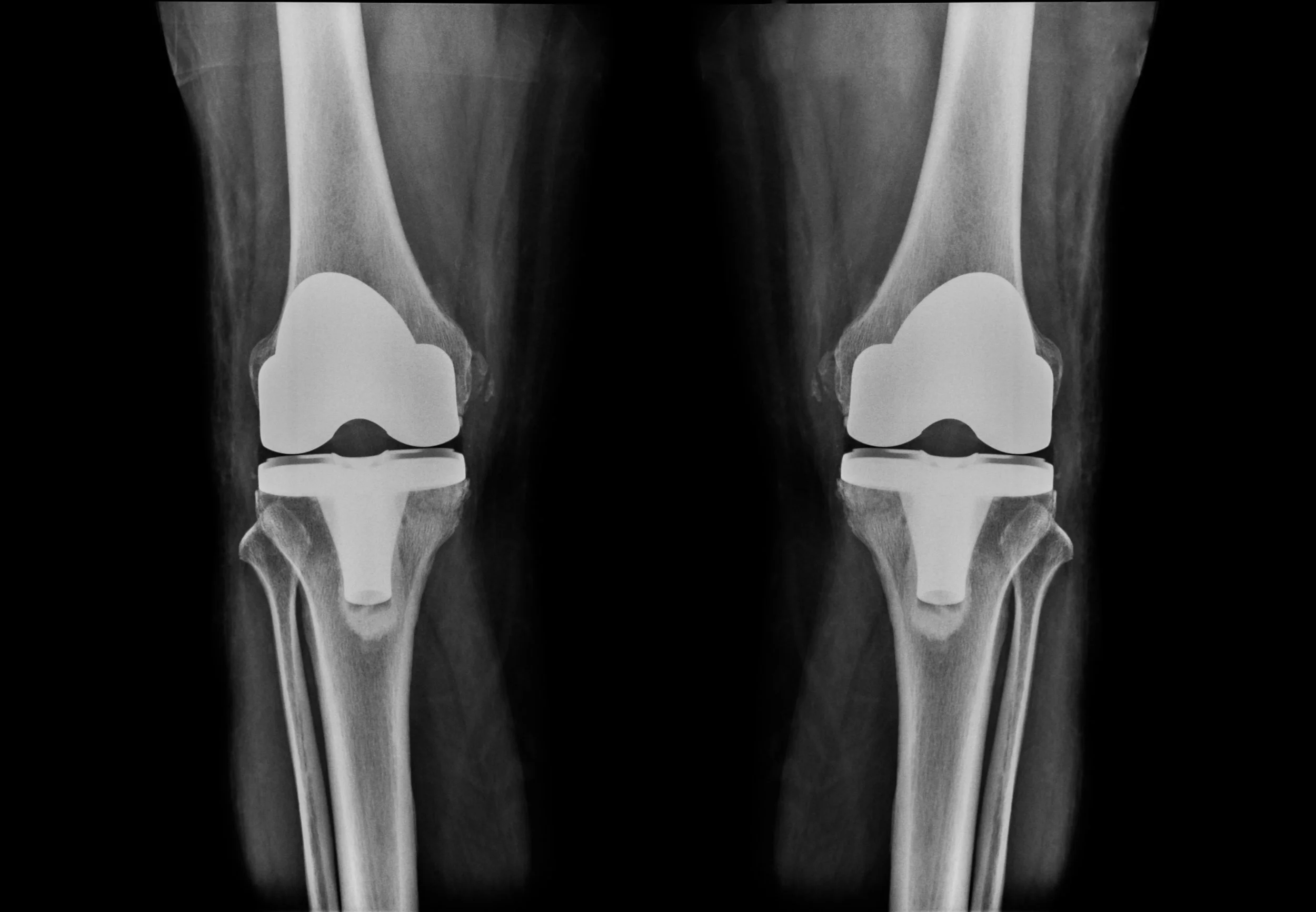 Total Joint Replacement Surgery