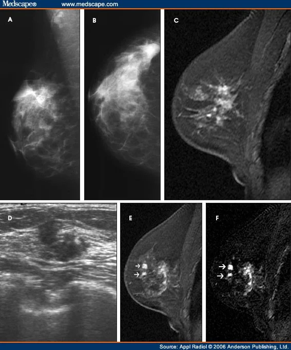 Lobular Carcinoma.jpg