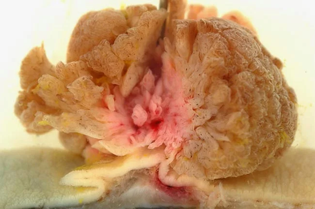 Villous_adenoma_of_the_sigmoid_colon,_gross_pathology.jpg