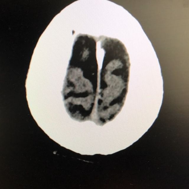 Pre-, 2 week post embo, and 6 week post embo CT scan for a patient treated with embolization of the left middle meningeal artery for acute on chronic subdural hematoma. 
Amazing promise for this new procedure!

#neuroscience #neurosurgery #neurosurge