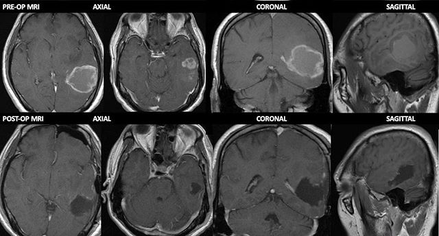 Pre and post operative MRI images following an awake craniotomy for tumor resection.  This type of surgery is done with the patient awake to allow for language and motor mapping and real time assessment of brain function during removal of tumors clos