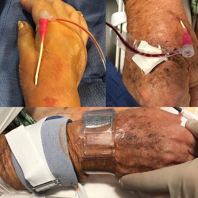 Continuing to push the boundaries of endovascular therapy for vascular disorders of the brain. Brain aneurysms and strokes can be treated with arterial access from a small puncture on the back of the hand - the distal radial artery, with only a small