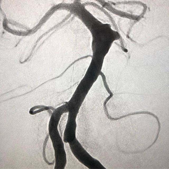#radialforneuro stent-assisted coiling of a ruptured fusiform mid-basilar aneurysm with distal radial access

#neuroscience #neurosurgery #neurosurgeon #neuro #neurology #radiology #neuroradiology #medicine #medschool #medstudent #science #health #he